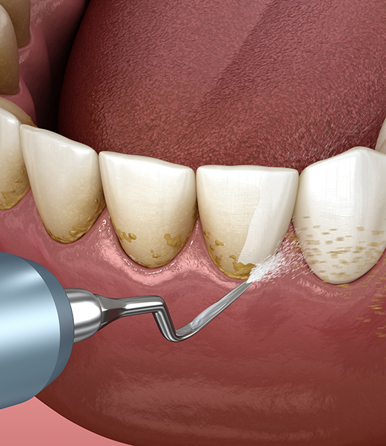 Illustration of a dental scaler clearing tartar from the gums and teeth