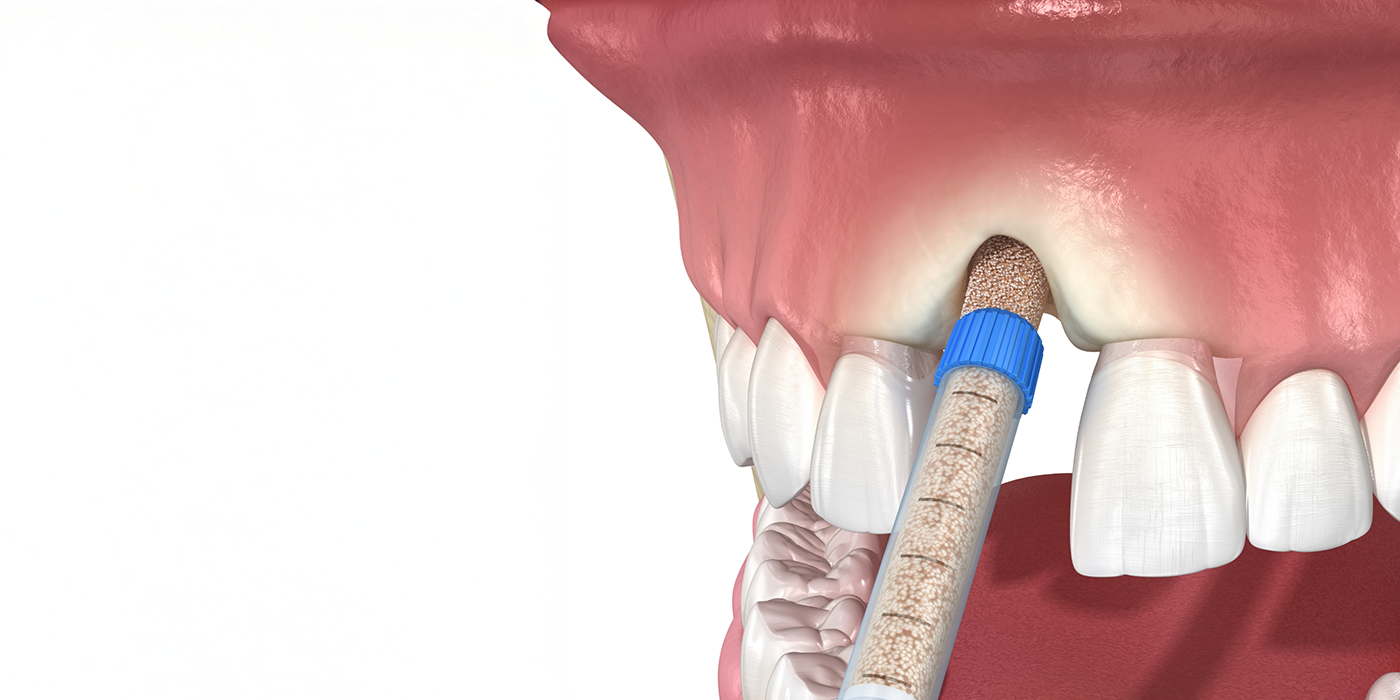 Illustration of bone grafting material being placed in the upper jawbone