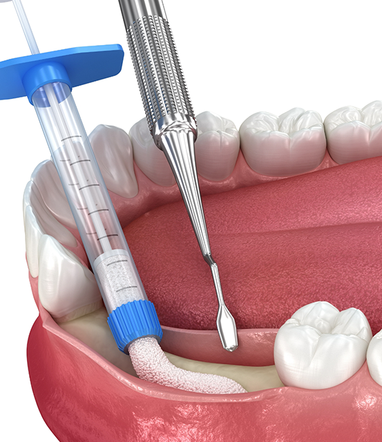 Illustrated bone graft