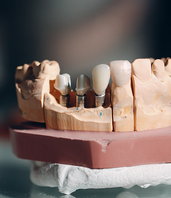 Model of the mouth with dental implants