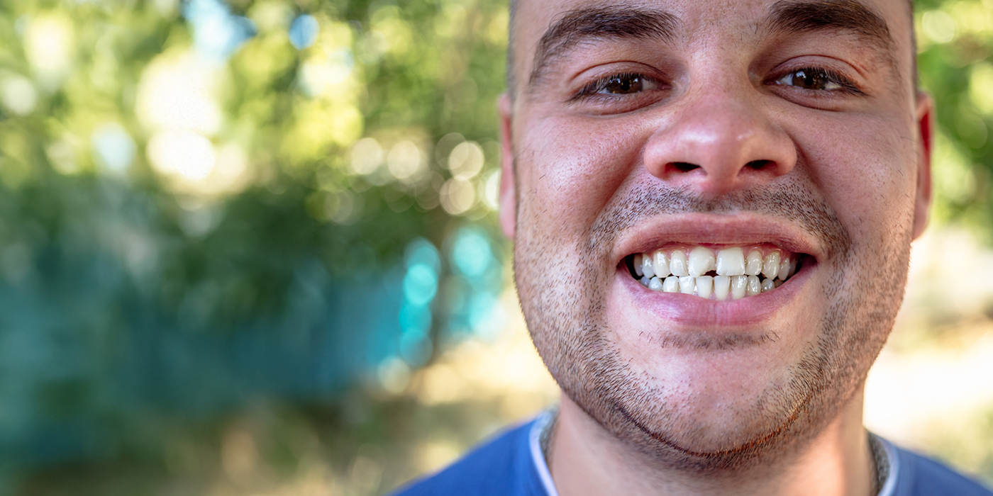 Man smiling with a chipped tooth before dental bonding in Fort Worth