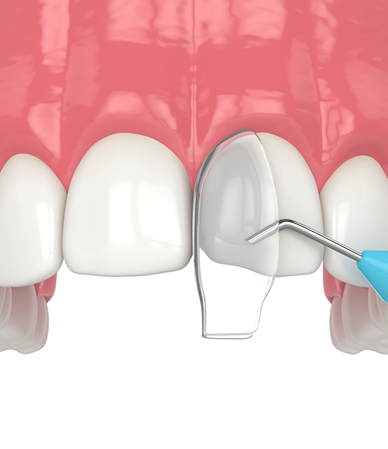 Illustration of a chipped upper front tooth getting dental bonding