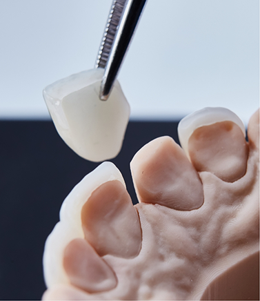 Tweezers holding a veneer