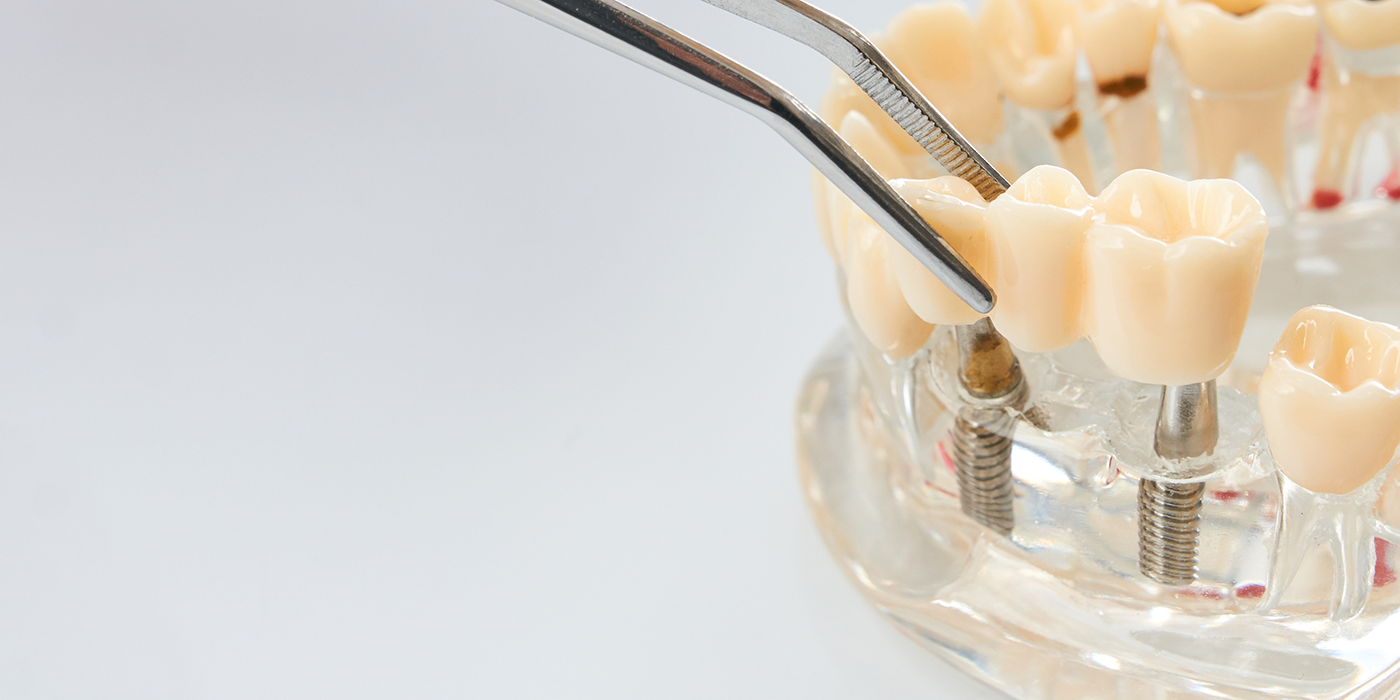 Model of a dental bridge replacing three missing teeth