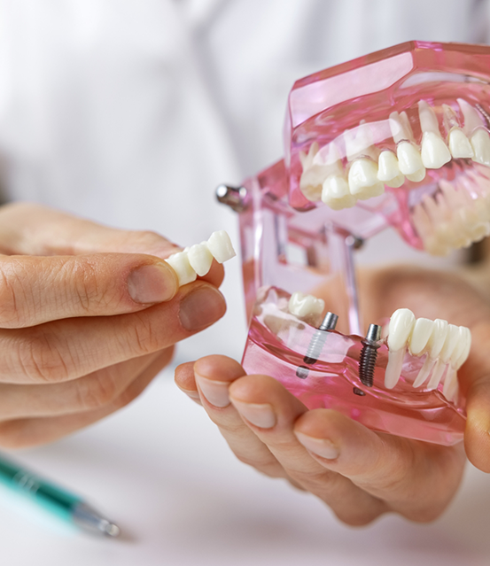Dentist holding a dental bridge and a model of the mouth