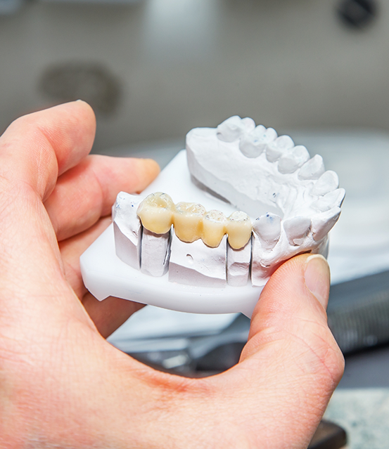 Hand holding a model of the mouth with a dental bridge