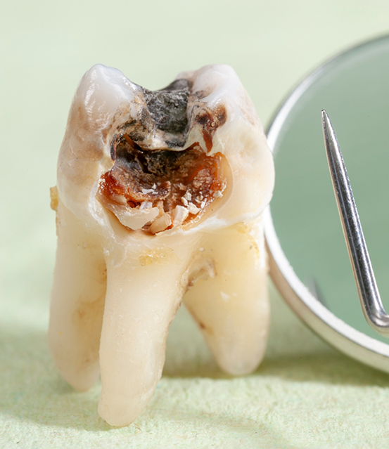Close up of a heavily decayed tooth