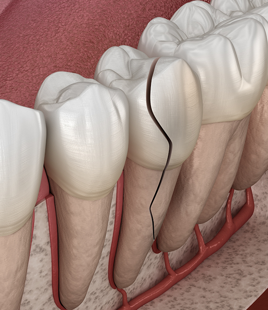 Illustration of a cracked tooth