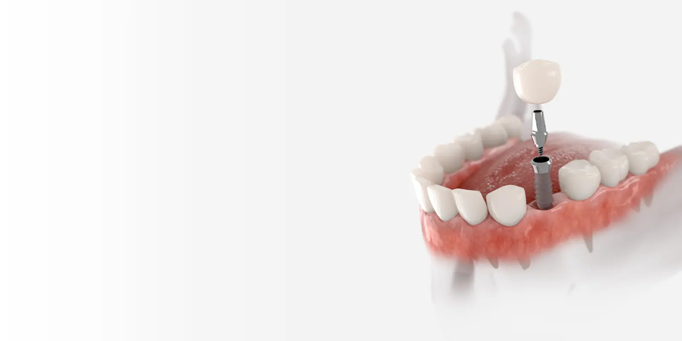 Model of a dental implant in Fort Worth