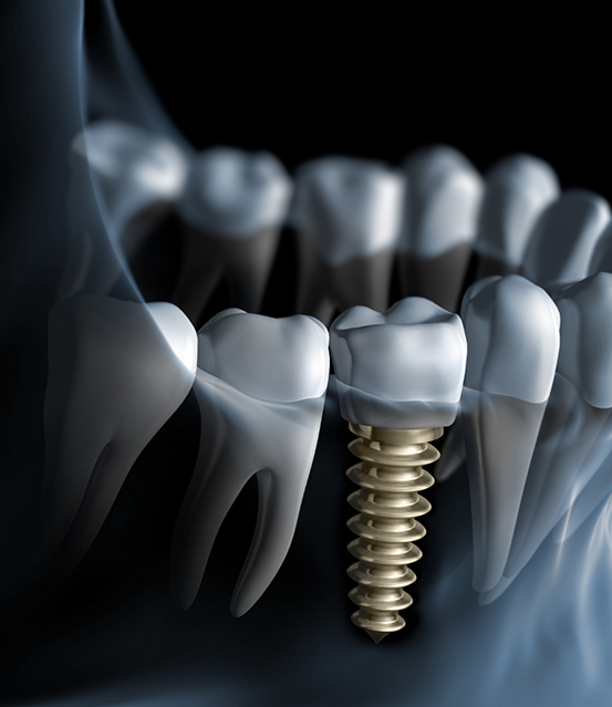 Illustrated x ray of a person with a dental implant