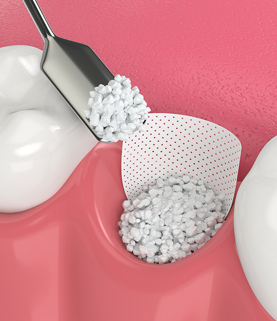 Illustrated bone grafting material being placed in the jawbone
