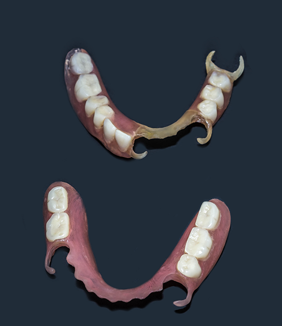 Two partial dentures