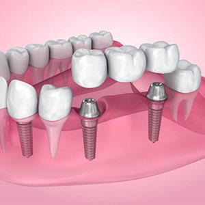 Exploded illustration of dental implants with bridge