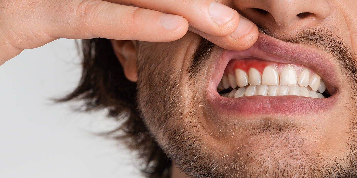 Man pointing to his red gums before gum disease treatment in Fort Worth
