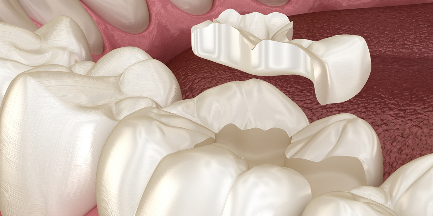 Illustration of a dental inlay being placed to restore a chipped tooth