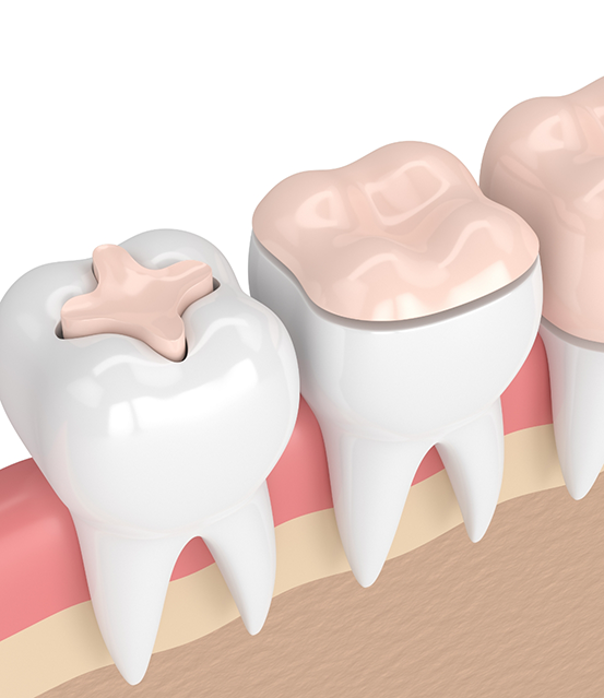 Illustration of a tooth with an inlay, a tooth with an onlay, and a tooth with a crown