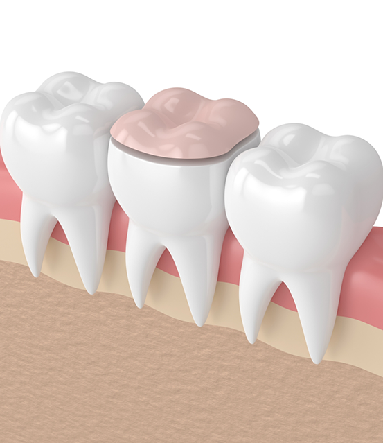 Illustration of a tooth with an onlay