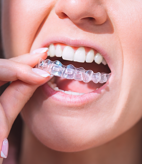 Close up of a woman placing Invisalign over her teeth