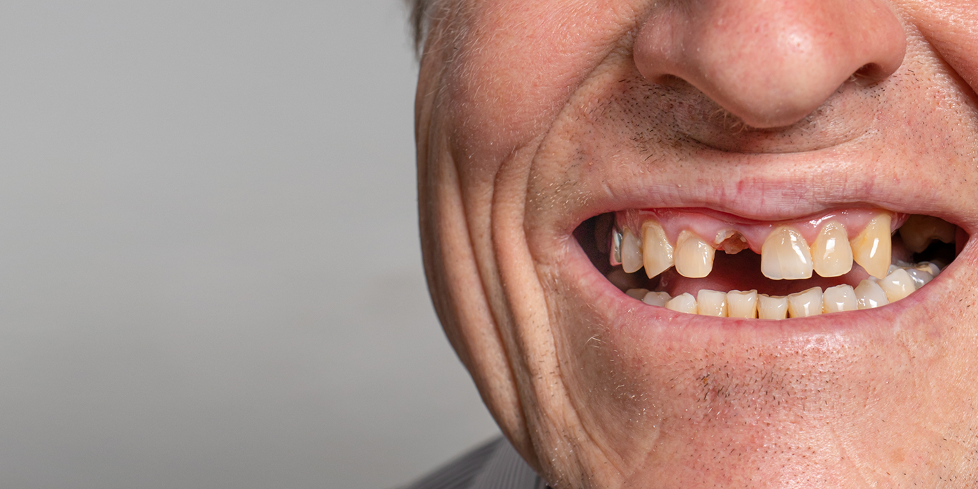Close up of a smile with a missing front tooth