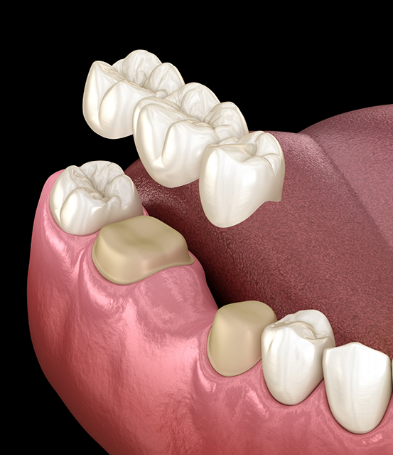 Illustration of a dental bridge replacing a missing tooth