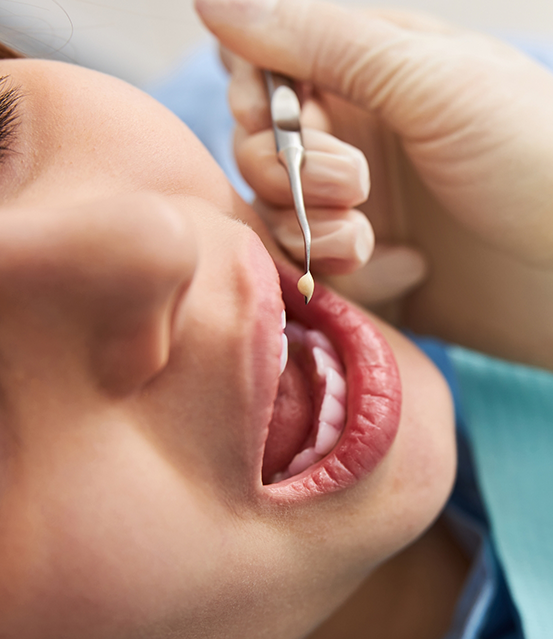 Close up of a dentist placing a white filling in a tooth