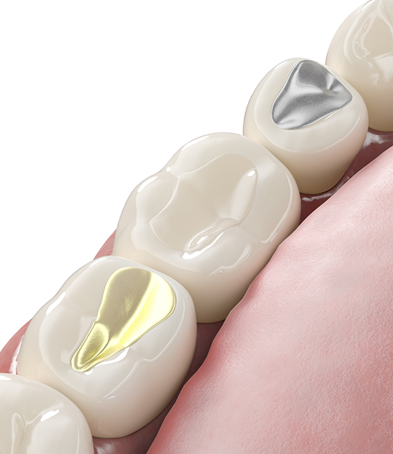 Illustration of teeth with white, silver, and gold fillings