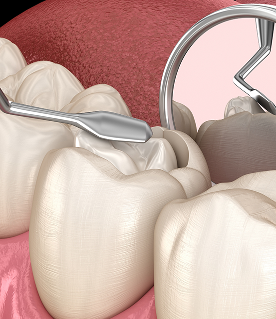 Illustration of a white filling being placed in a tooth