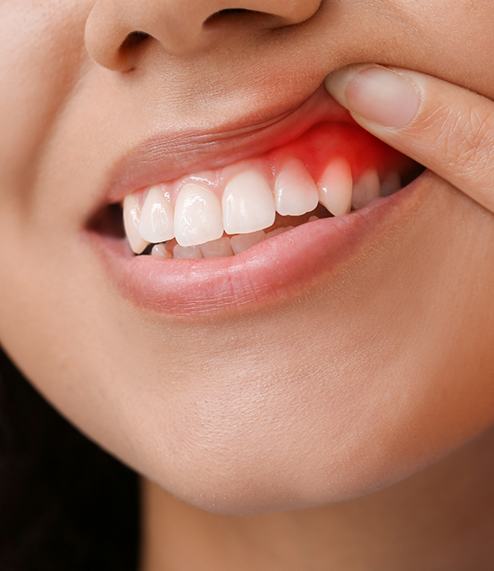 Person pointing to a red spot in their gums