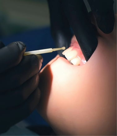 Dental patient having fluoride applied to their teeth