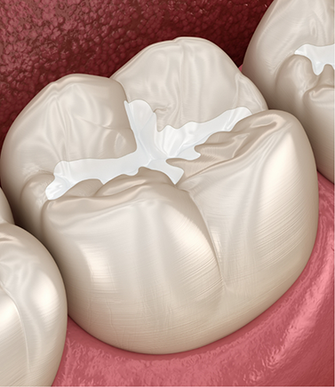 Illustration of a tooth with a white filling