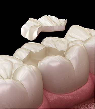 Illustrated inlay being placed to restore a chipped tooth