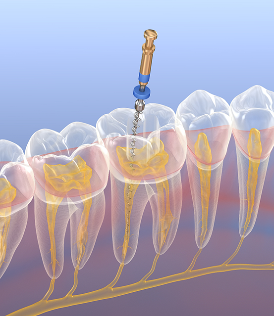 Illustrated tooth receiving root canal treatment