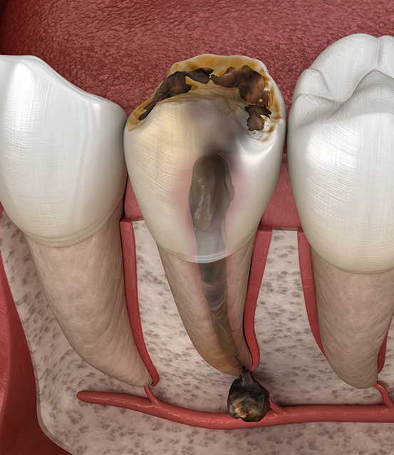 Illustration of a severely decayed tooth