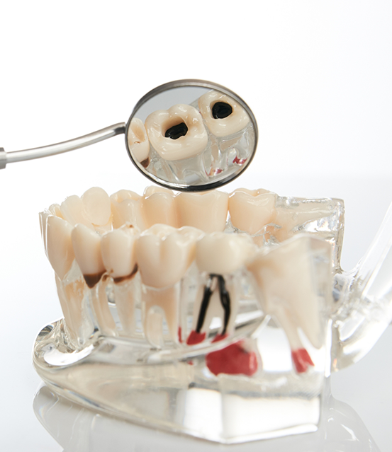 Model of the mouth with a decayed tooth