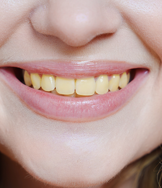 Smile with yellowed teeth