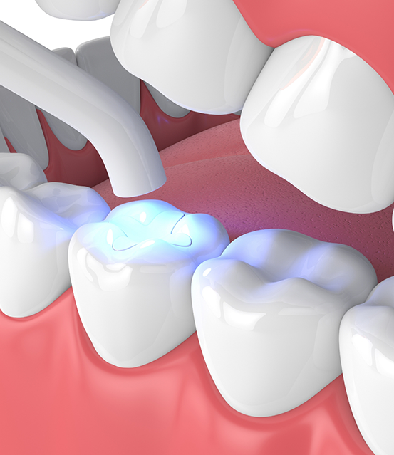 Illustration of a white filling being placed in a tooth