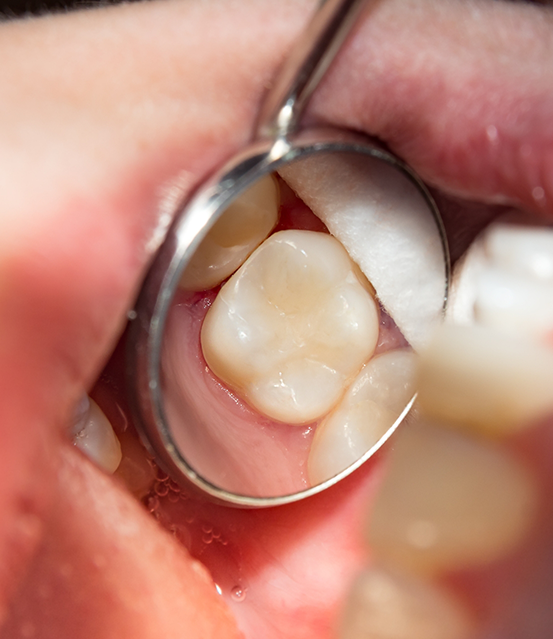 Dental mirror reflecting a white tooth