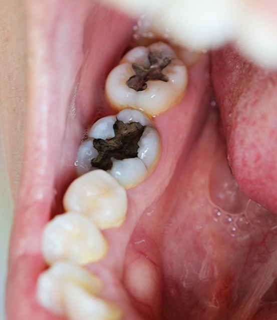 Close up of a damaged tooth