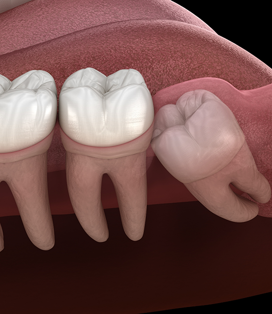 Illustration of an impacted wisdom tooth pressing against the adjacent tooth