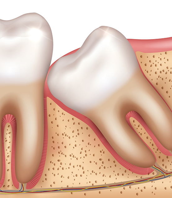 Illustrated impacted wisdom tooth
