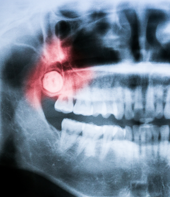 X ray showing an impacted wisdom tooth